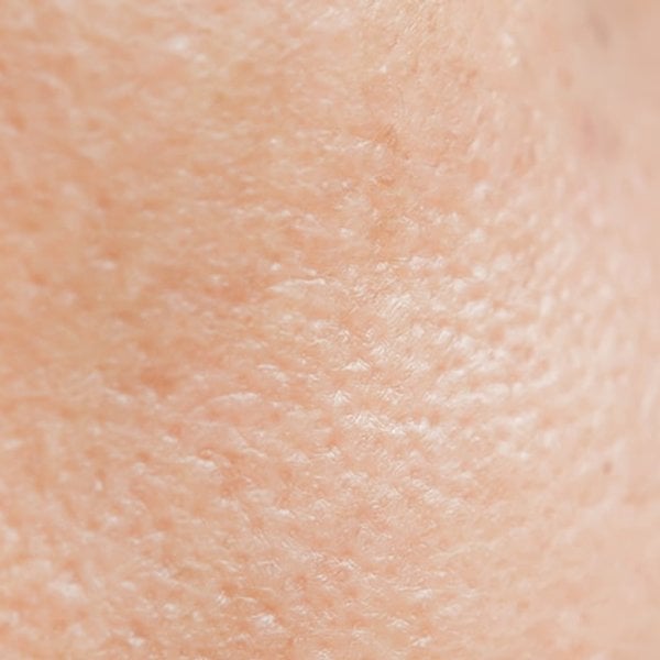 Artículo sobre el acné - imagen principal