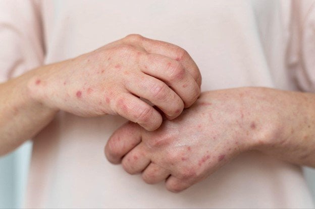 dermatitis en las manos