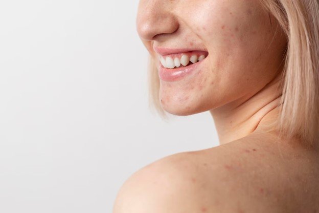 acne adolescente