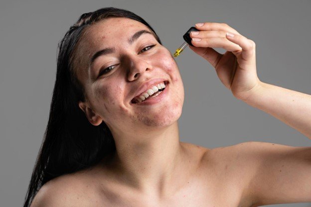 exfoliación piel grasa