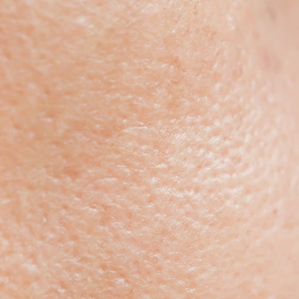 Artículo sobre el acné - imagen principal