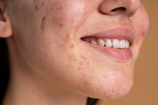 tipos de acne