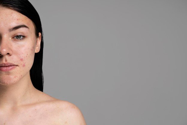 tipos de acne
