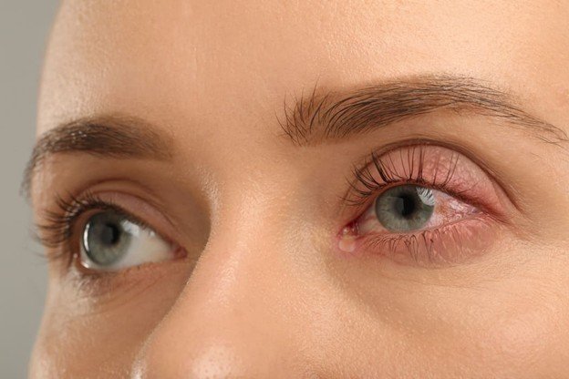 alergia en los parpados 
