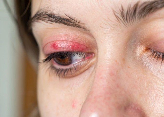 alergia alrededor de los ojos