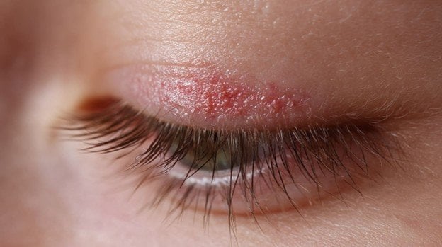 <strong>Alergia en los párpados: causas comunes y soluciones</strong>