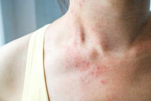 eccema alergico