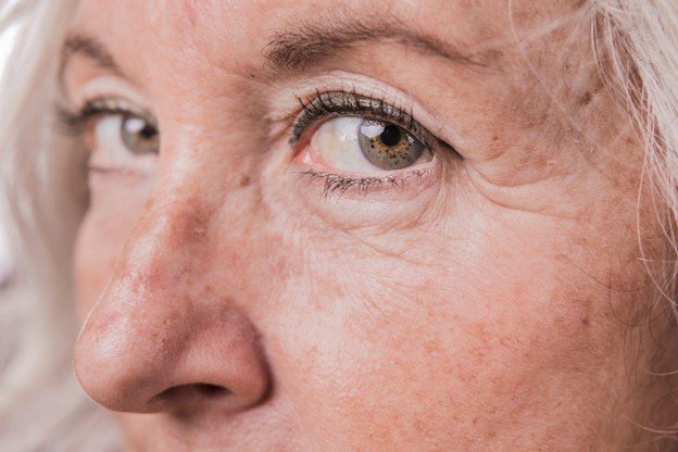 correccion de ojeras