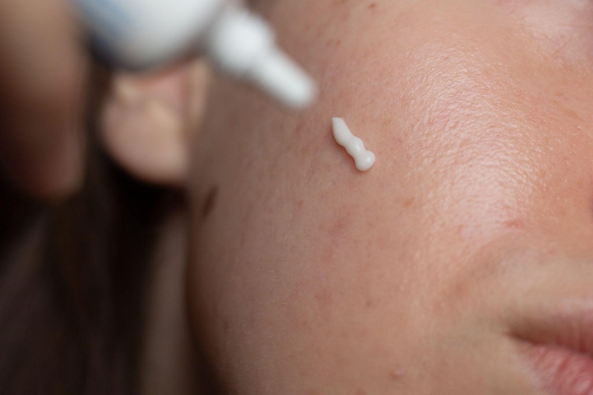 la hiperpigmentación postinflamatoria desaparece