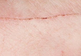 Larocheposay ArticlePage Damaged How to optimise scar healing
