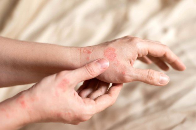 crema para la dermatitis