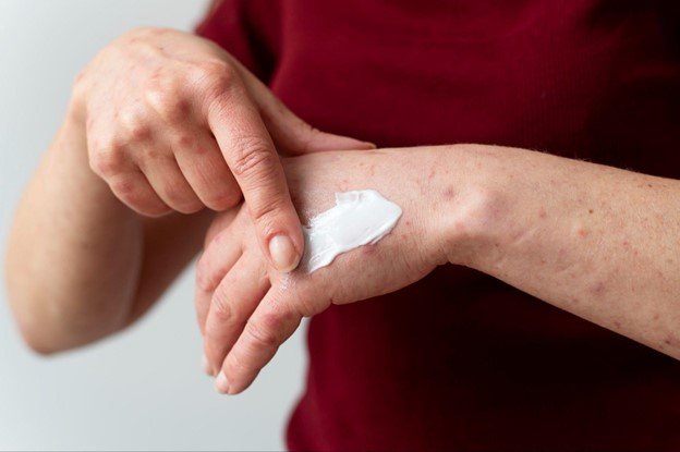 eczema manos estres