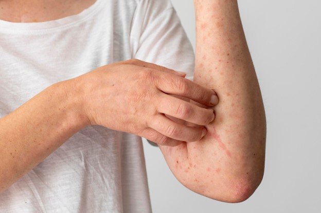 dermatitis atopica sintomas