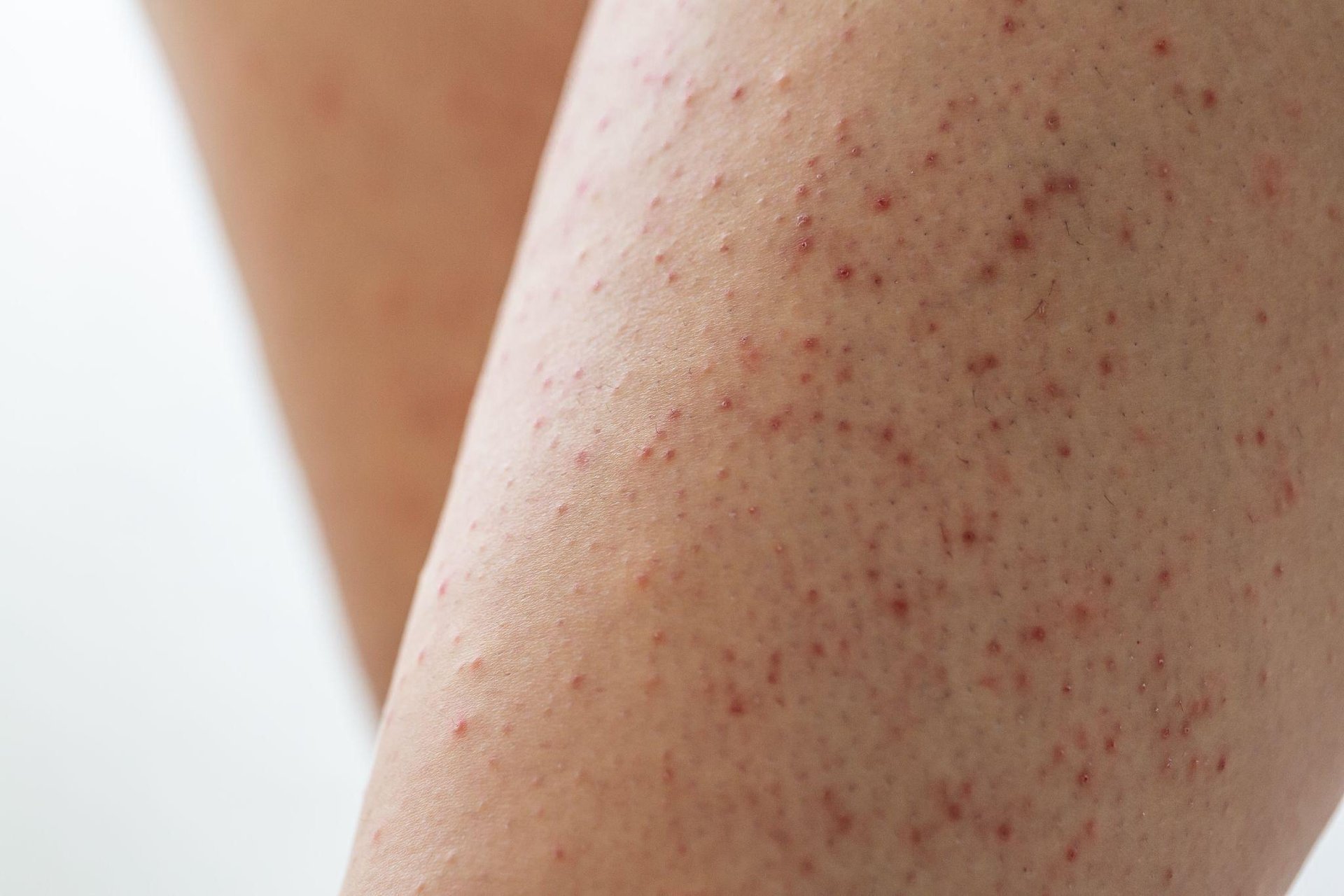 queratosis pilaris que es