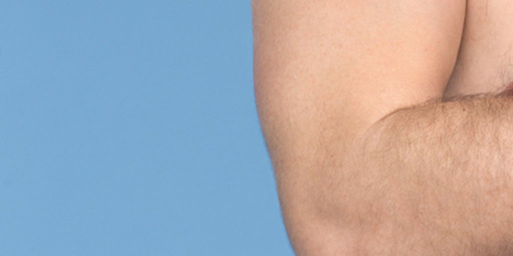 <strong>PSORIASIS:</strong> CAUSAS, SÍNTOMAS Y TRATAMIENTOS