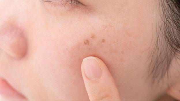 vitamina b3 para las manchas