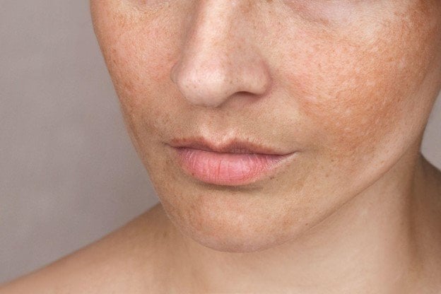 <strong>Vitamina B3 para reducir las manchas en la cara</strong>