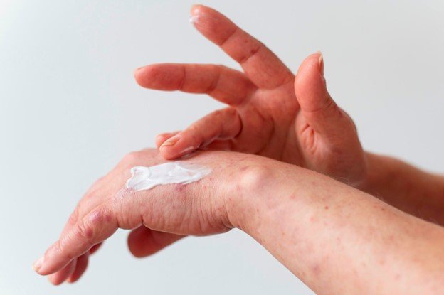 dishidrosis