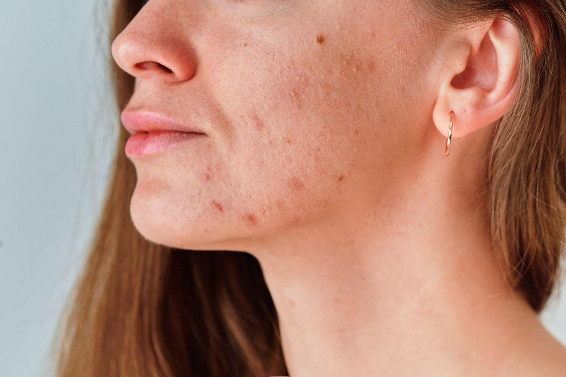que es la foliculitis