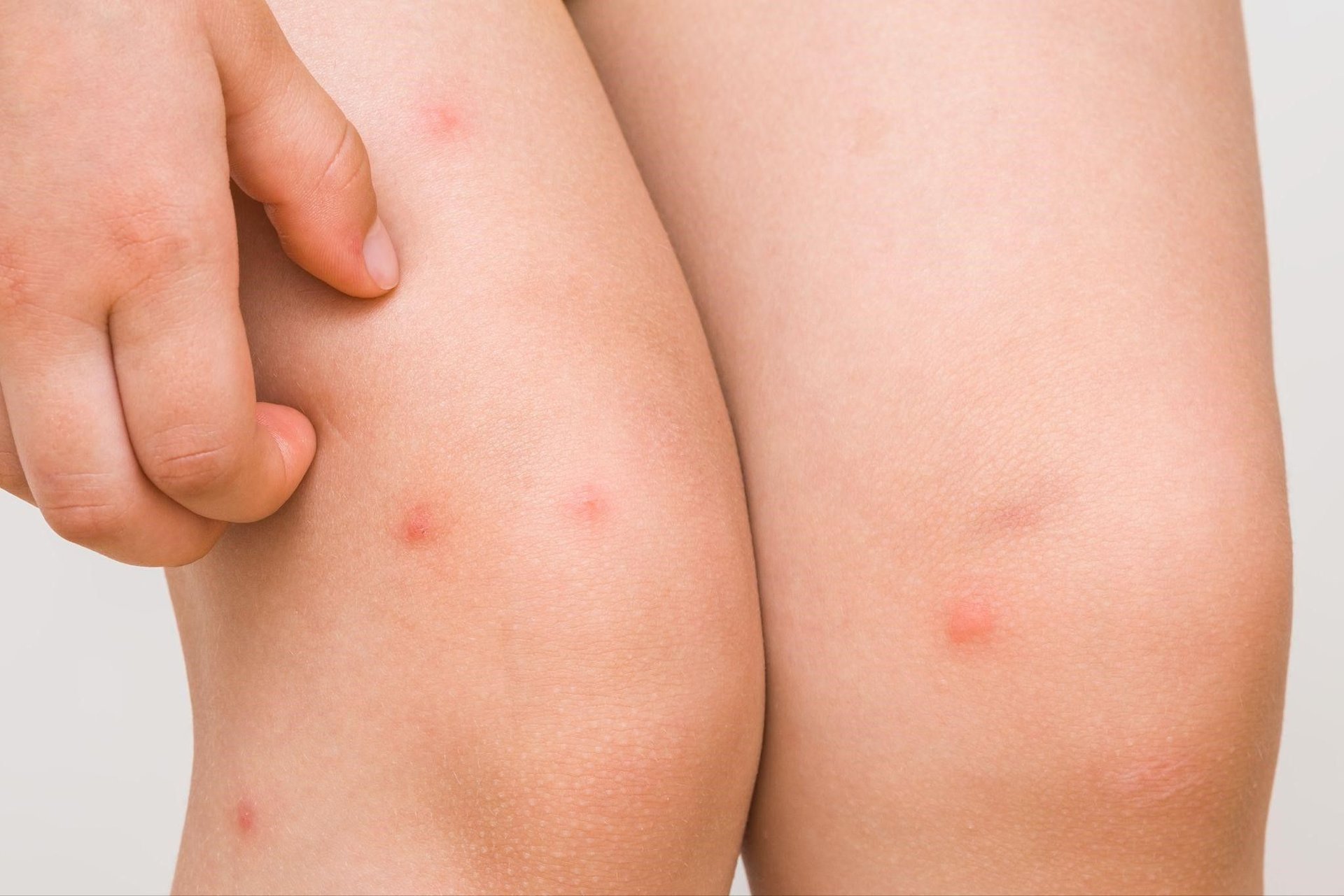 foliculitis en las piernas