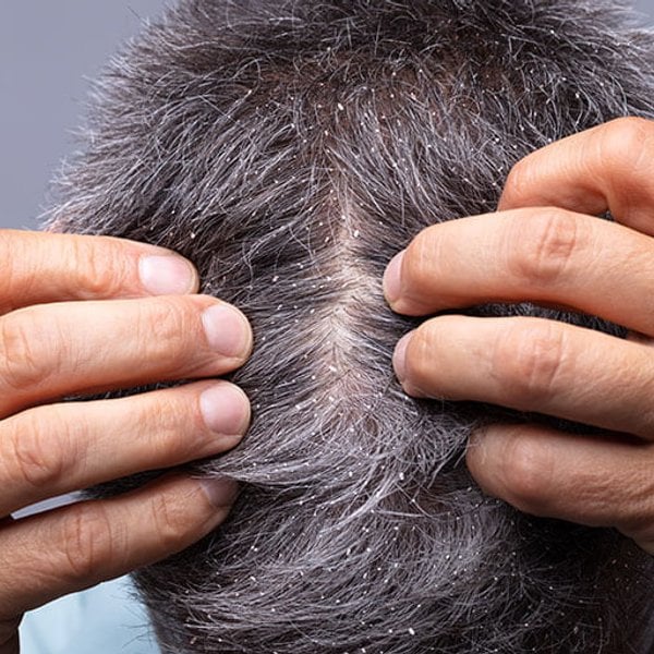 excepción barbería Se asemeja Por qué aparece la caspa? ¿Cómo la elimino? : causas, tratamientos y  productos de La Roche-Posay de La Roche-Posay
