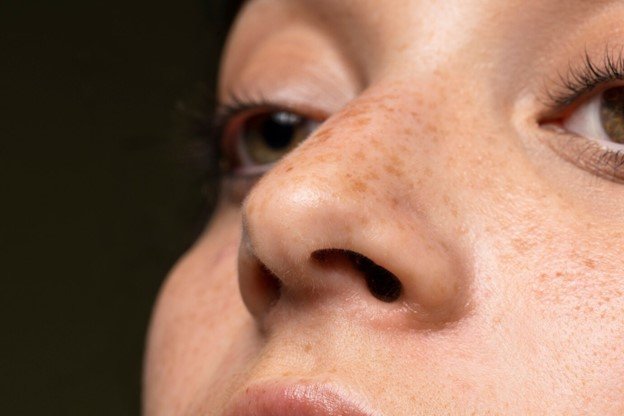 melasma facial