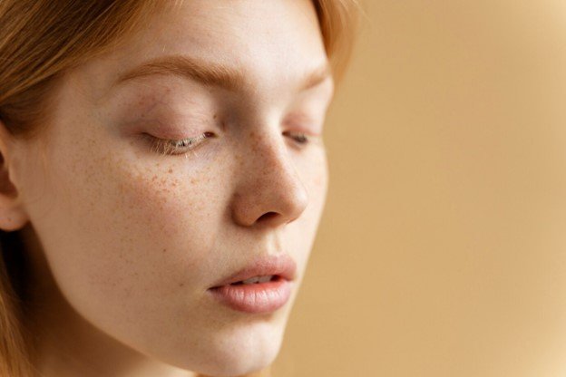 melasma tratamiento