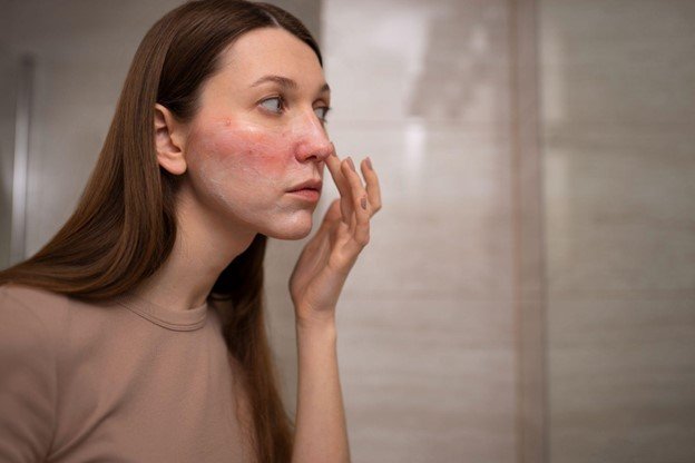 que es rosacea