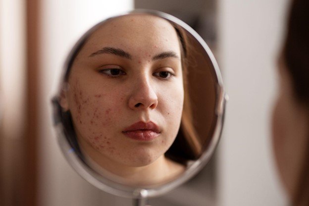 rosacea en la cara