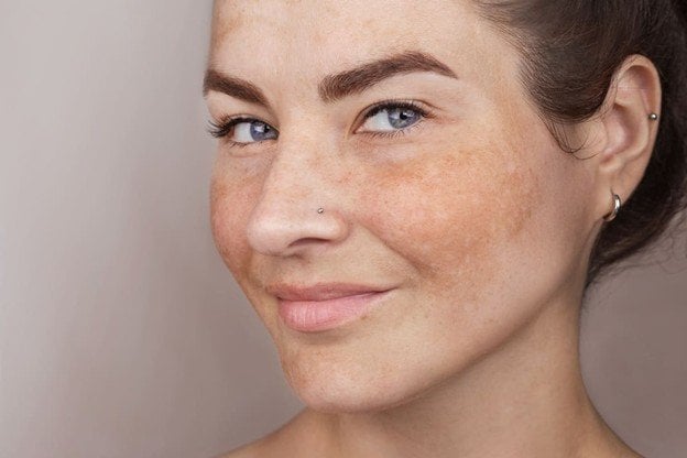 <strong>Lentigos solares: qué son y cómo prevenirlos</strong>