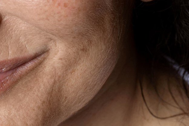 pigmentación por la edad