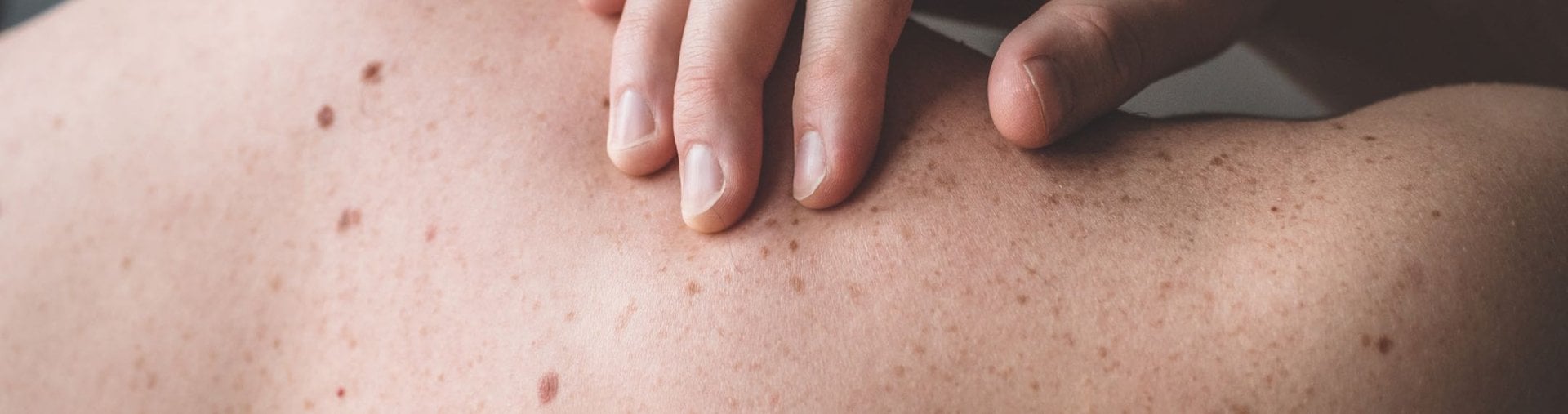 <strong>PROTECTORES SOLARES Y PREVENCIÓN DEL CÁNCER: </strong> TODO LO QUE NECESITAS SABER